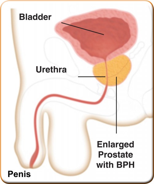 Male anatomy showing size of enlarged prostate.