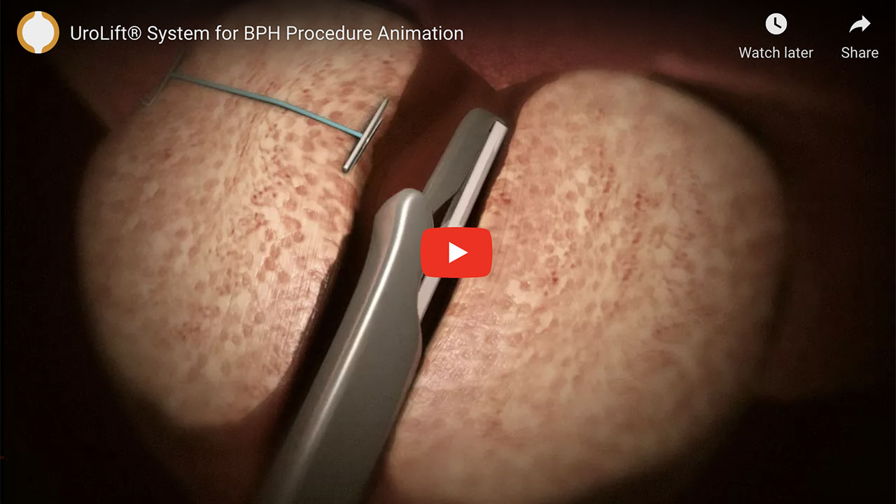 YouTube video of UroLift® System for BPH Procedure Animation