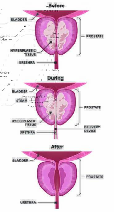 Anatomy of the male prostate before, during, and after the Rezum procedure.